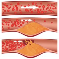 cholesterol.jpg